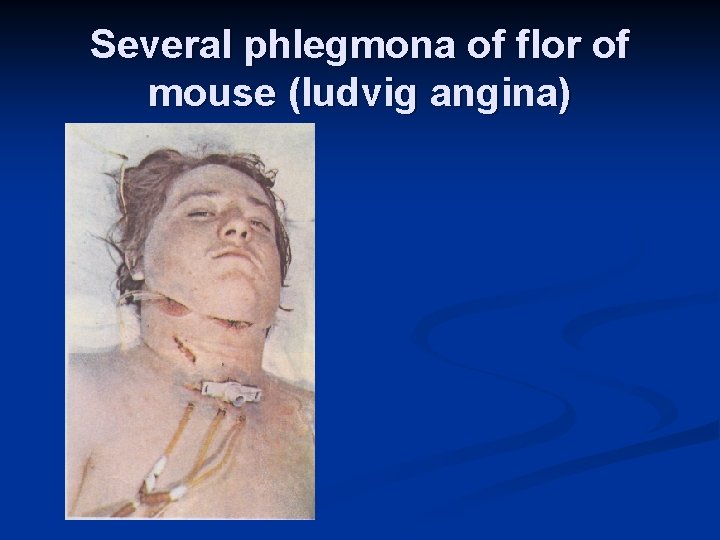 Several phlegmona of flor of mouse (ludvig angina) 
