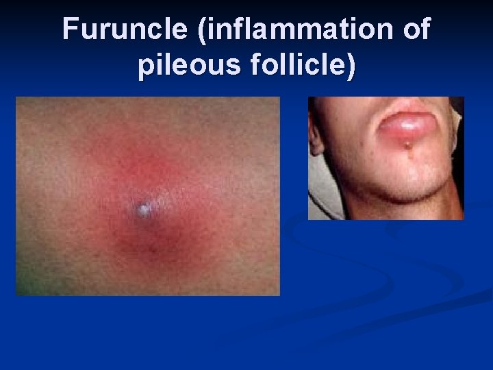 Furuncle (inflammation of pileous follicle) 