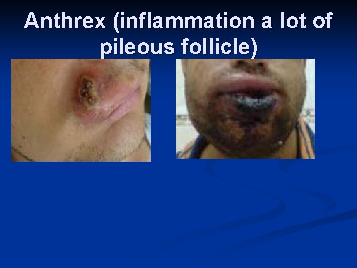 Anthrex (inflammation a lot of pileous follicle) 