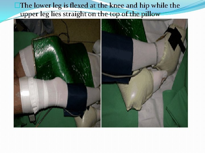 �The lower leg is flexed at the knee and hip while the upper leg