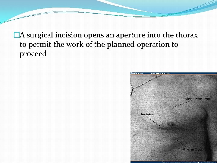 �A surgical incision opens an aperture into the thorax to permit the work of