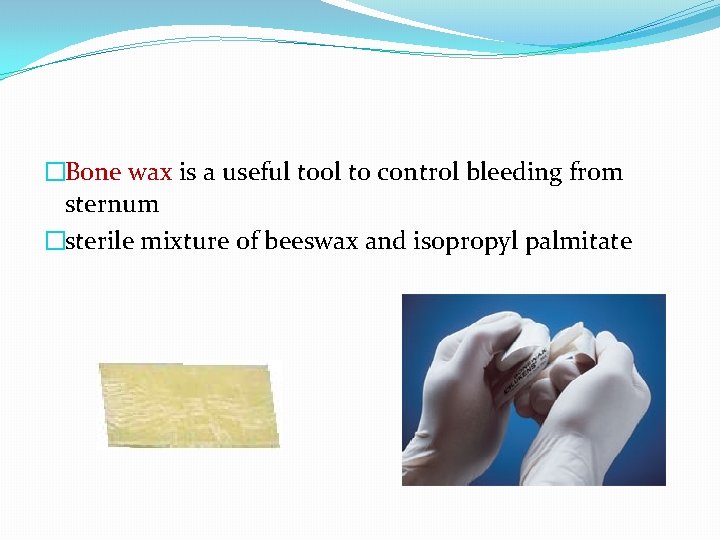 �Bone wax is a useful tool to control bleeding from sternum �sterile mixture of