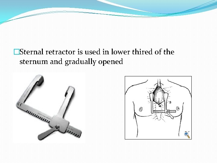 �Sternal retractor is used in lower thired of the sternum and gradually opened 