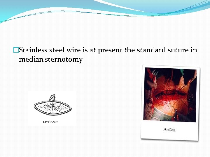 �Stainless steel wire is at present the standard suture in median sternotomy 