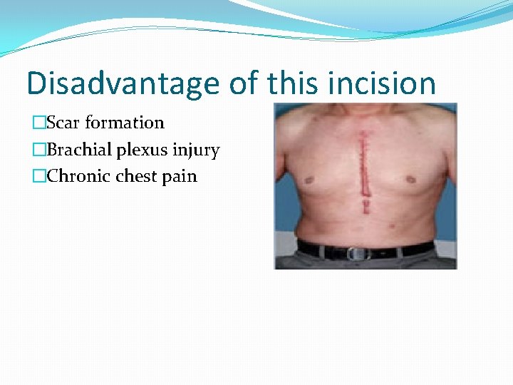 Disadvantage of this incision �Scar formation �Brachial plexus injury �Chronic chest pain 