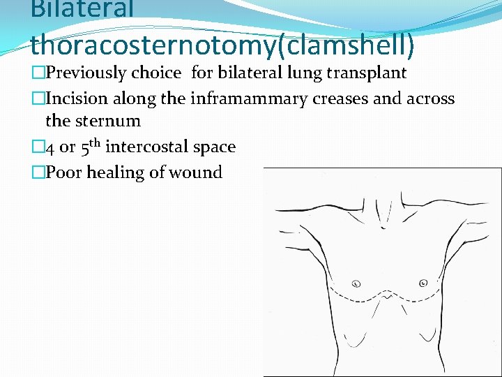 Bilateral thoracosternotomy(clamshell) �Previously choice for bilateral lung transplant �Incision along the inframammary creases and