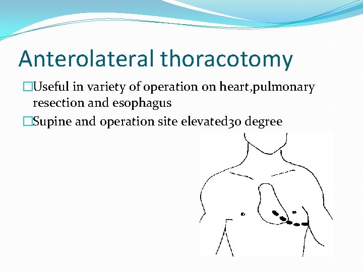 Anterolateral thoracotomy �Useful in variety of operation on heart, pulmonary resection and esophagus �Supine
