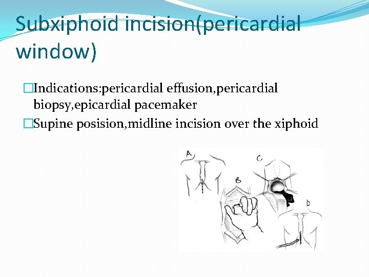 Subxiphoid incision(pericardial window) �Indications: pericardial effusion, pericardial biopsy, epicardial pacemaker �Supine posision, midline incision