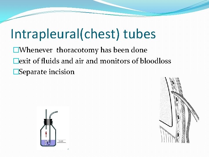 Intrapleural(chest) tubes �Whenever thoracotomy has been done �exit of fluids and air and monitors