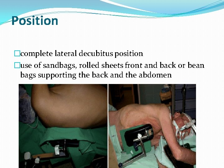 Position �complete lateral decubitus position �use of sandbags, rolled sheets front and back or