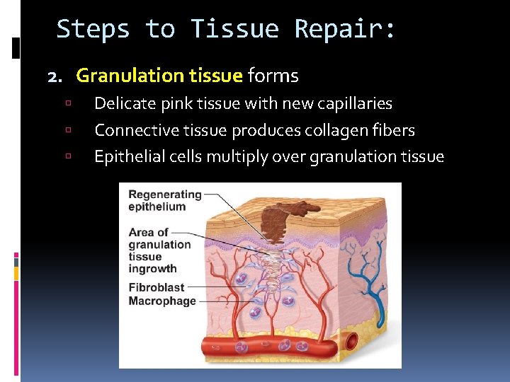 Steps to Tissue Repair: 2. Granulation tissue forms Delicate pink tissue with new capillaries