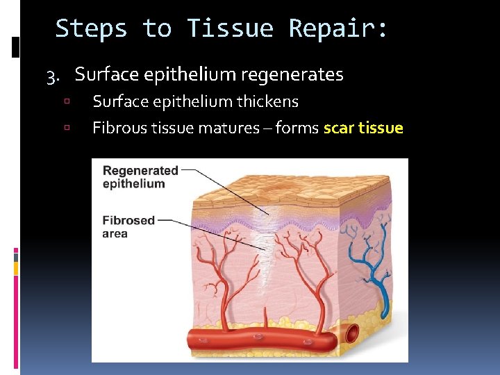 Steps to Tissue Repair: 3. Surface epithelium regenerates Surface epithelium thickens Fibrous tissue matures