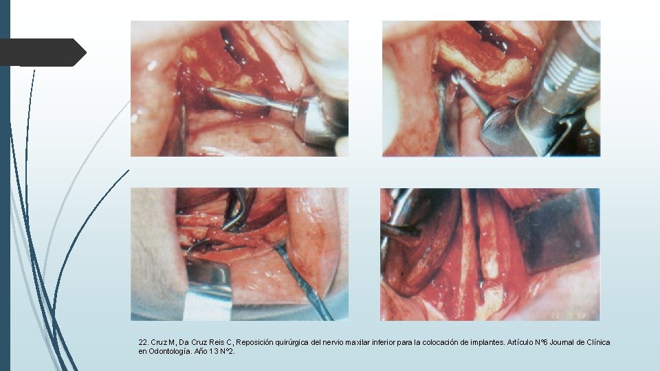 22. Cruz M, Da Cruz Reis C, Reposición quirúrgica del nervio maxilar inferior para 22. Cruz M, Da Cruz Reis C, Reposición quirúrgica del nervio maxilar inferior para