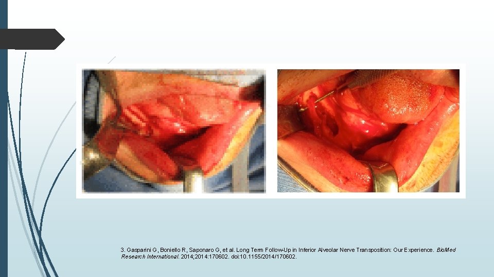 3. Gasparini G, Boniello R, Saponaro G, et al. Long Term Follow-Up in Inferior 3. Gasparini G, Boniello R, Saponaro G, et al. Long Term Follow-Up in Inferior