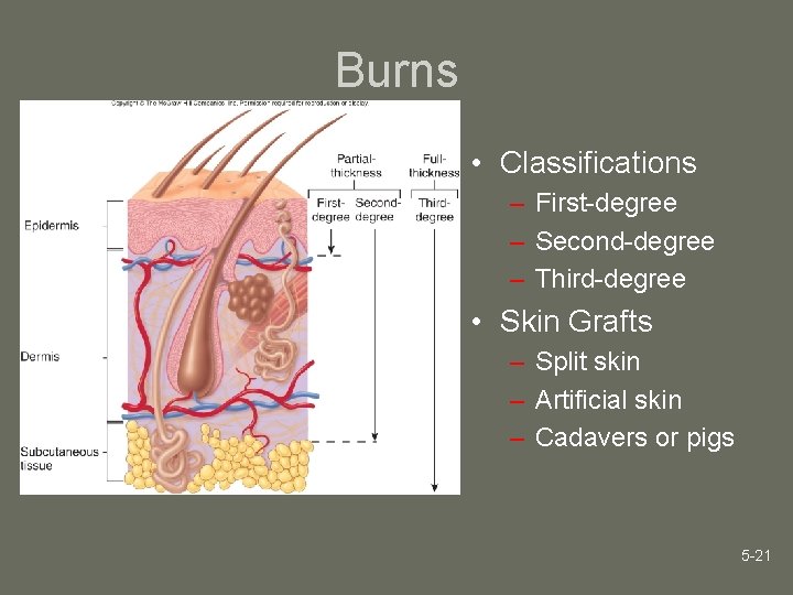 Burns • Classifications – First-degree – Second-degree – Third-degree • Skin Grafts – Split