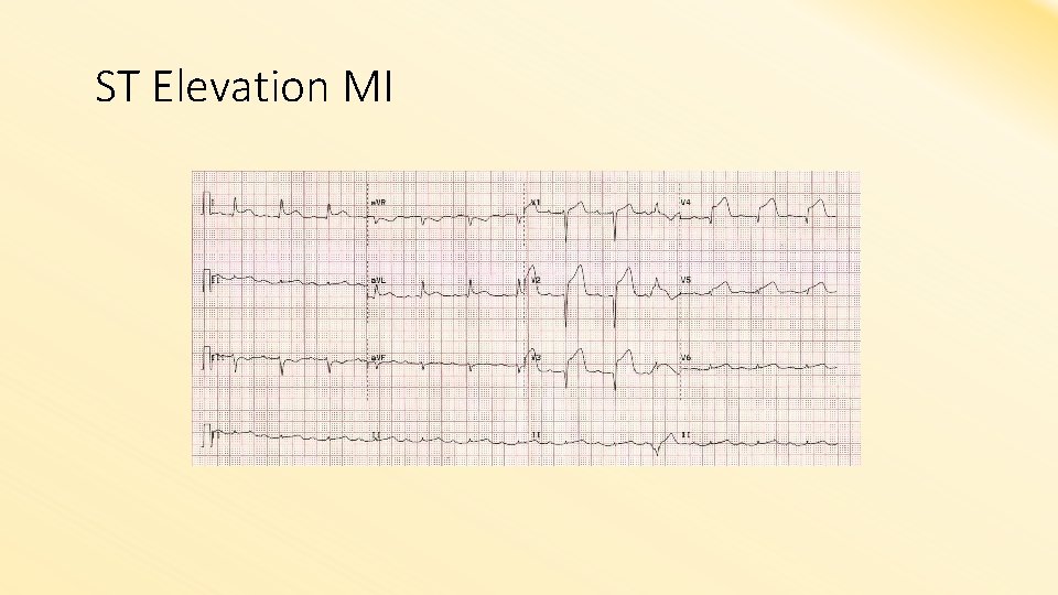 ST Elevation MI 