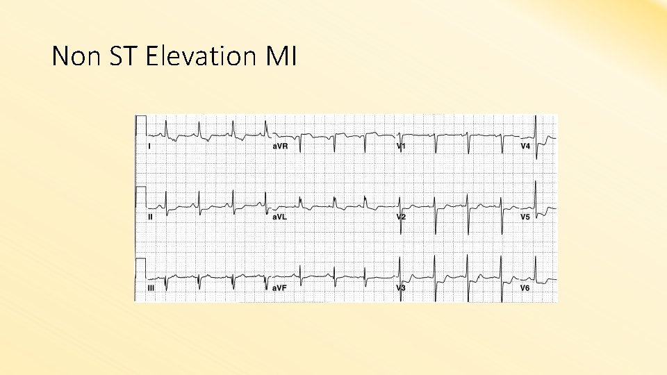 Non ST Elevation MI 