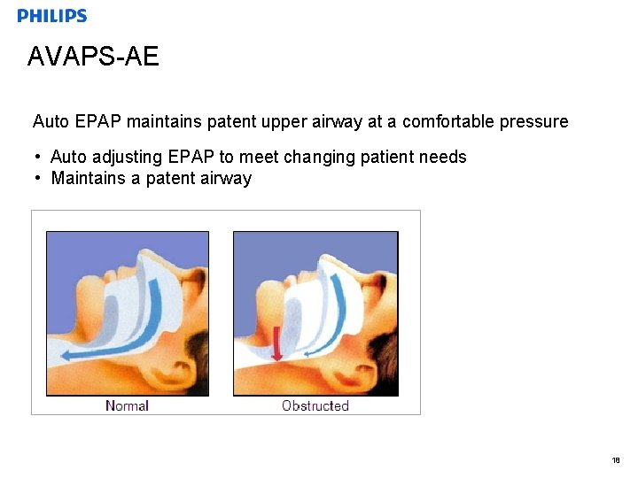 AVAPS-AE Auto EPAP maintains patent upper airway at a comfortable pressure • Auto adjusting