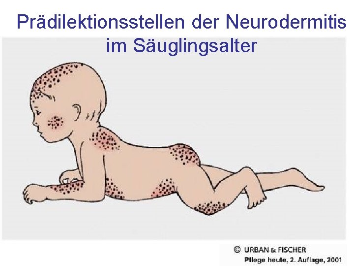 Prädilektionsstellen der Neurodermitis im Säuglingsalter 