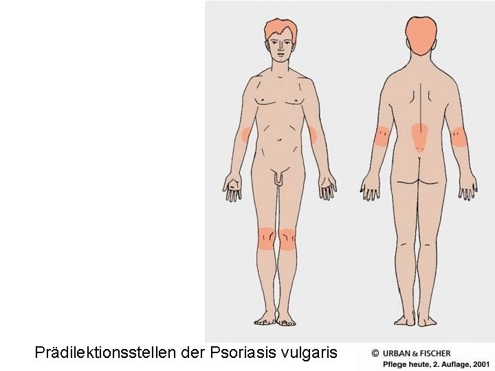 Prädilektionsstellen der Psoriasis vulgaris 
