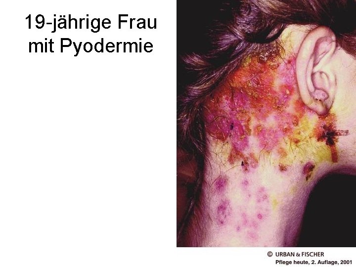 19 -jährige Frau mit Pyodermie 