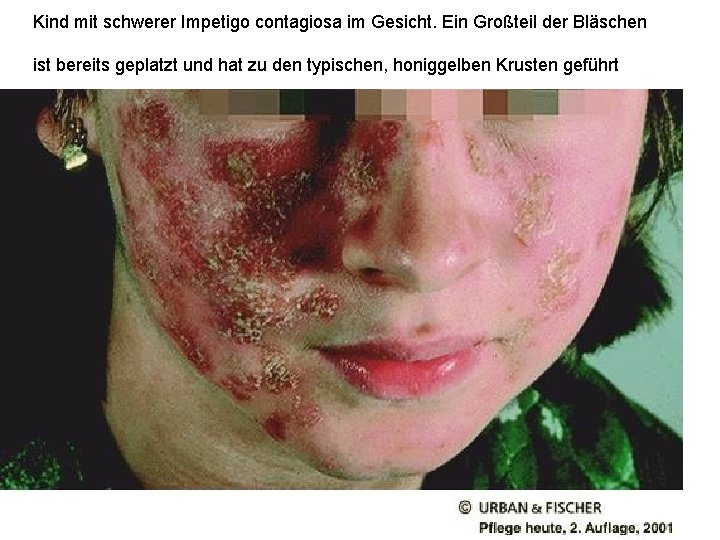 Kind mit schwerer Impetigo contagiosa im Gesicht. Ein Großteil der Bläschen ist bereits geplatzt