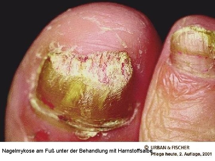 Nagelmykose am Fuß unter der Behandlung mit Harnstoffsalbe 