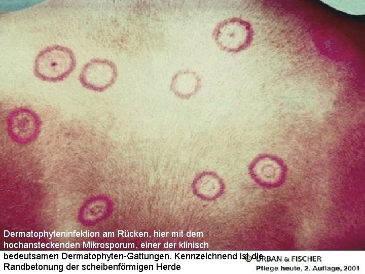 Dermatophyteninfektion am Rücken, hier mit dem hochansteckenden Mikrosporum, einer der klinisch bedeutsamen Dermatophyten-Gattungen. Kennzeichnend
