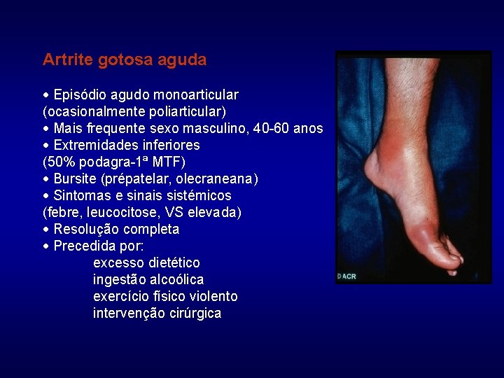 artrite monoarticular)
