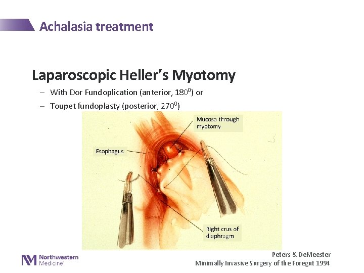 Achalasia treatment Laparoscopic Heller’s Myotomy - With Dor Fundoplication (anterior, 1800) or - Toupet