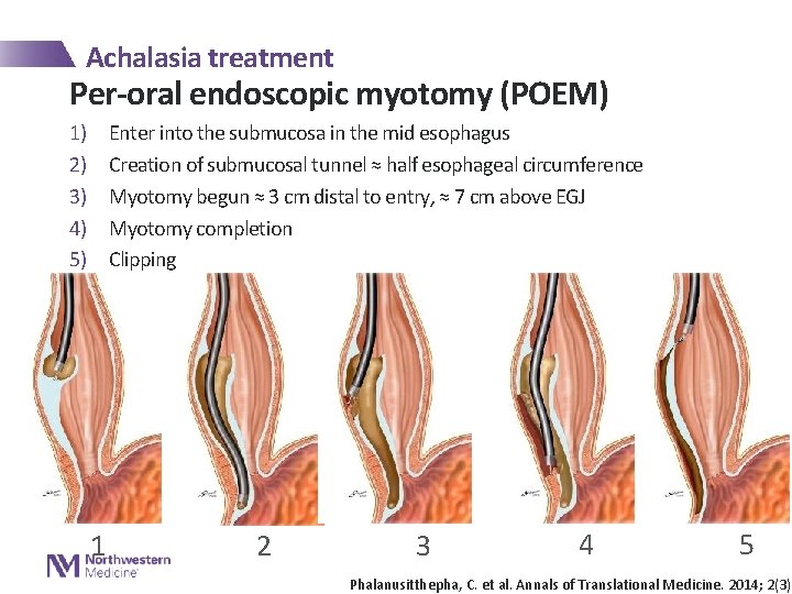 Achalasia treatment Per-oral endoscopic myotomy (POEM) 1) 2) 3) 4) 5) Enter into the