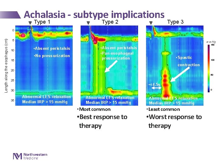 Achalasia - subtype implications Type 1 Type 2 Type 3 Length along the esophagus