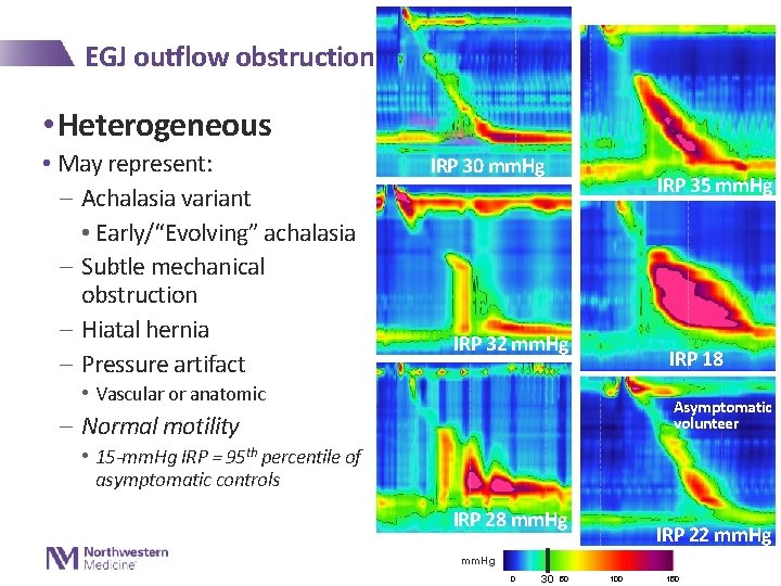 EGJ outflow obstruction • Heterogeneous • May represent: - Achalasia variant • Early/“Evolving” achalasia