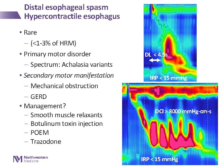 Distal esophageal spasm Hypercontractile esophagus • Rare - (<1 -3% of HRM) • Primary