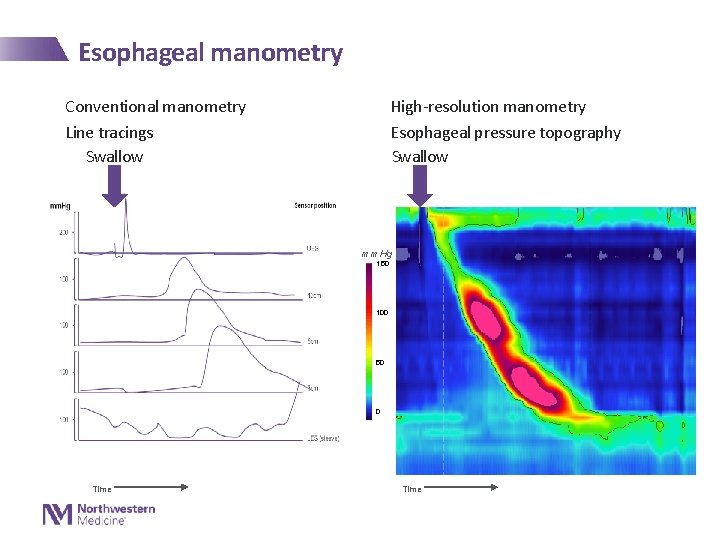 Esophageal manometry Conventional manometry Line tracings Swallow High-resolution manometry Esophageal pressure topography Swallow mm.