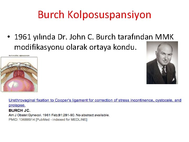 Burch Kolposuspansiyon • 1961 yılında Dr. John C. Burch tarafından MMK modifikasyonu olarak ortaya