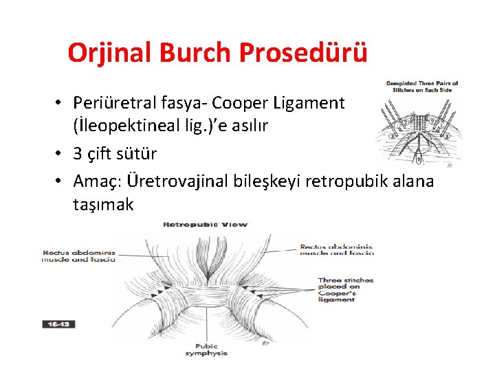 Orjinal Burch Prosedürü • Periüretral fasya- Cooper Ligament (İleopektineal lig. )’e asılır • 3