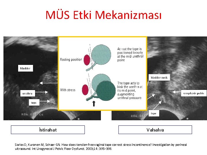 MÜS Etki Mekanizması İstirahat Valsalva Sarlos D, Kuronen M, Schaer GN. How does tension-free