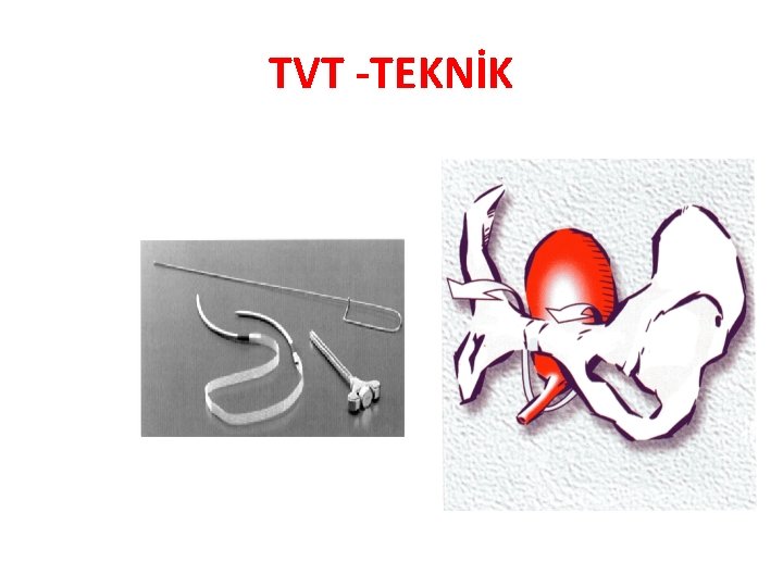 TVT -TEKNİK 