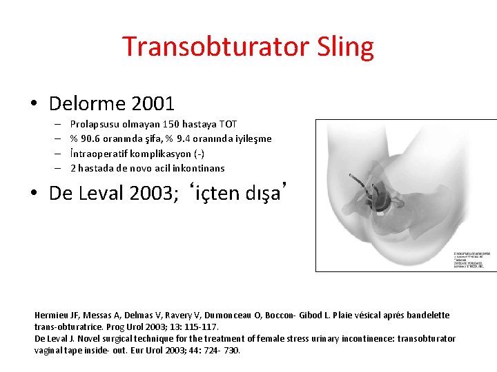 Transobturator Sling • Delorme 2001 – – Prolapsusu olmayan 150 hastaya TOT % 90.