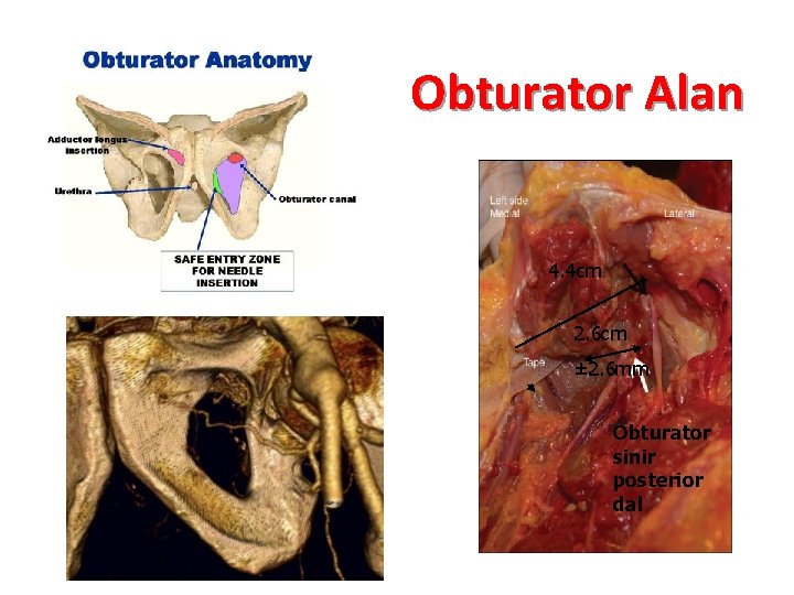 Obturator Alan 4. 4 cm 2. 6 cm ± 2. 6 mm Obturator sinir