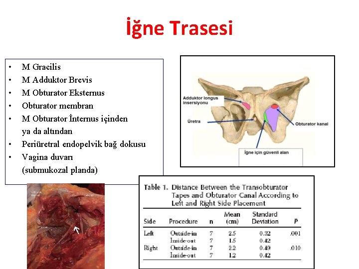 İğne Trasesi • • M Gracilis M Adduktor Brevis M Obturator Eksternus Obturator membran