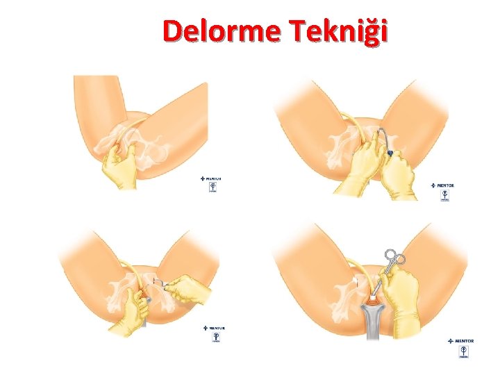 Delorme Tekniği 