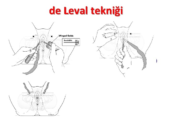 de Leval tekniği TVT-O (Gynecare) 