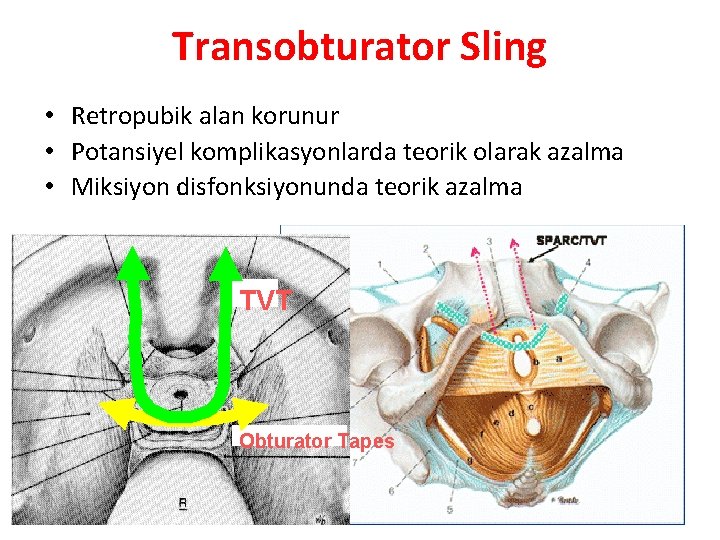 Transobturator Sling • Retropubik alan korunur • Potansiyel komplikasyonlarda teorik olarak azalma • Miksiyon