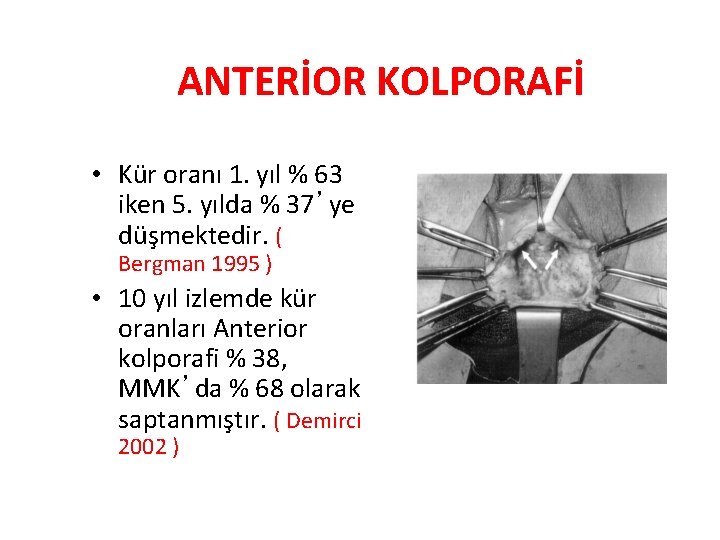 ANTERİOR KOLPORAFİ • Kür oranı 1. yıl % 63 iken 5. yılda % 37’ye