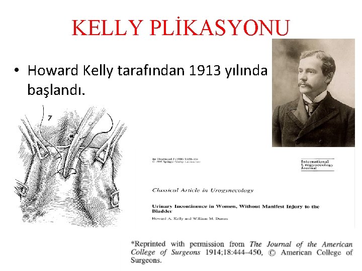 KELLY PLİKASYONU • Howard Kelly tarafından 1913 yılında yapılmaya başlandı. 