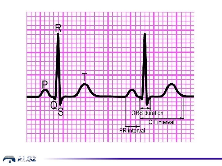 QRS Complex QRS Complex