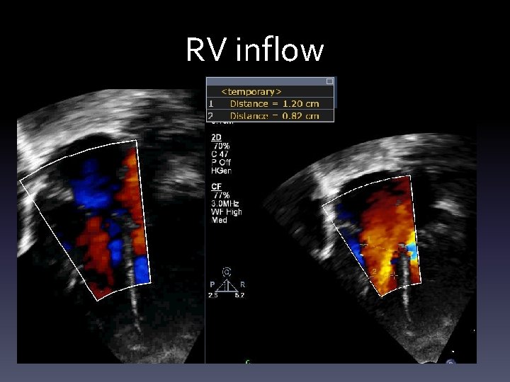 Congenital Heart Surgeon Society Atrioventricular Septal Defect prospective