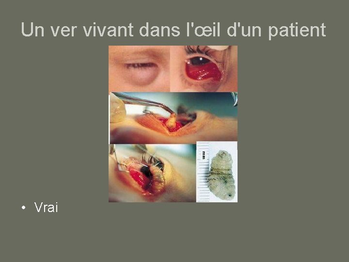 Un ver vivant dans l'œil d'un patient • Vrai 